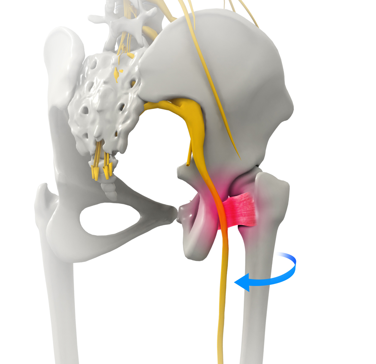 ischiofemoral-impingement-decompressionorland-park-il-hip